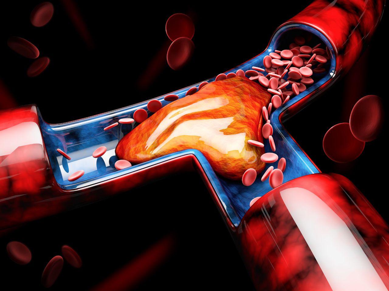 Mavie Work - Was ist Thrombose und wie gefährlich ist sie 2 - Blog Es gibt verschiedene Arten von Thrombose. Shutterstock.com / Victor Josan