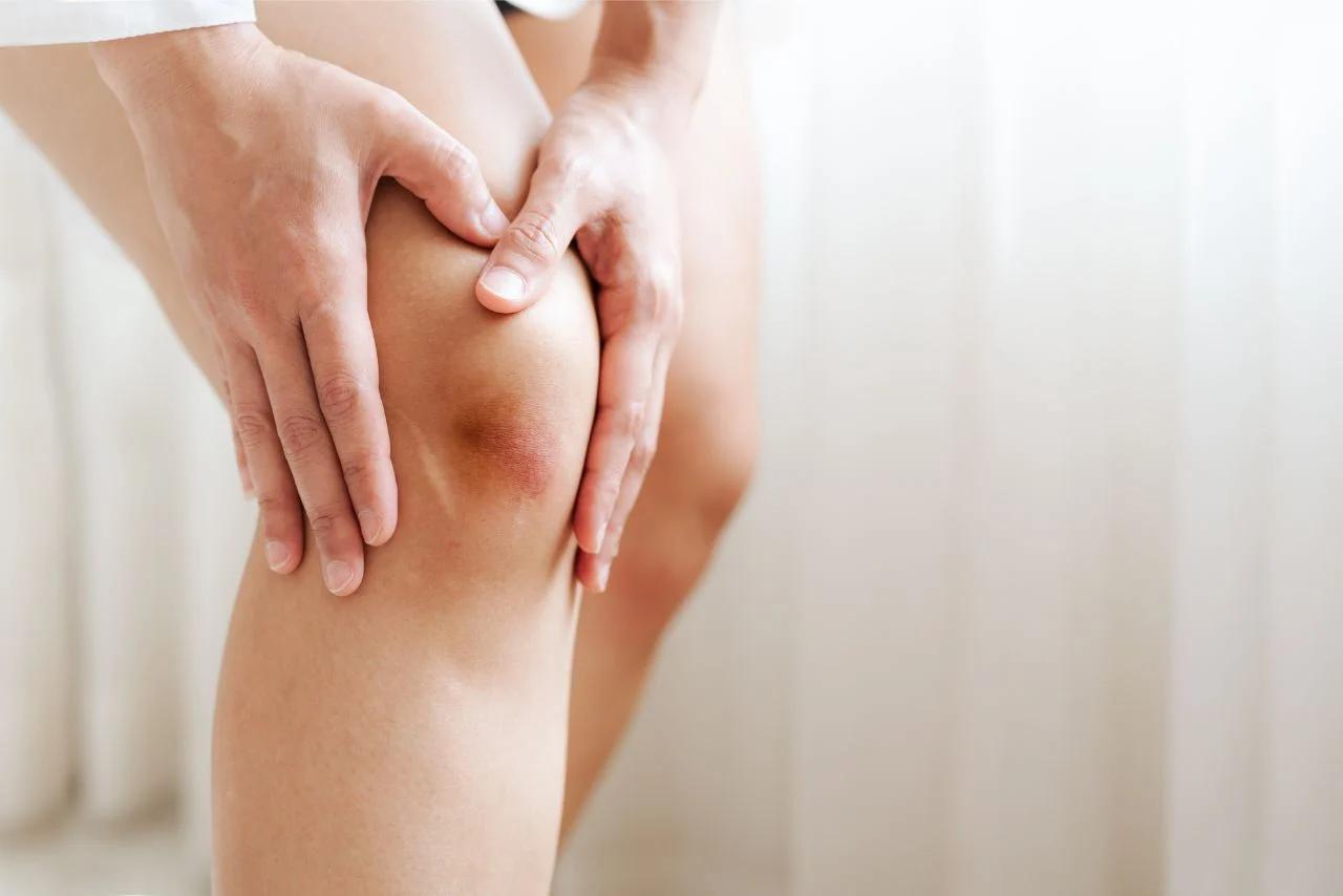 Mavie Work - Vitamin K2 Diese Krankheiten werden vorgebeugt 3 - Blog Bei einem Vitamin K Mangel entstehen leicht blaue Flecken. Shutterstock.com / BEAUTY STUDIO