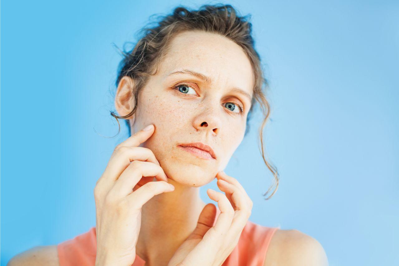 Mavie Work - Folsäuremangel erkennen 3 - Blog Unreine und blasse Haut kann ein Symptom eines Folsäuremangels sein. 
Shutterstock.com / Mila Supinskaya Glashchenko